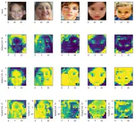Autism Disease Detection Using Quantum Transfer Learning Techniques